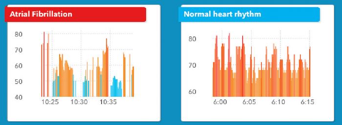 AI-equipped Apple Watch Can Detect Irregular Heartbeat and Signs of a Stroke